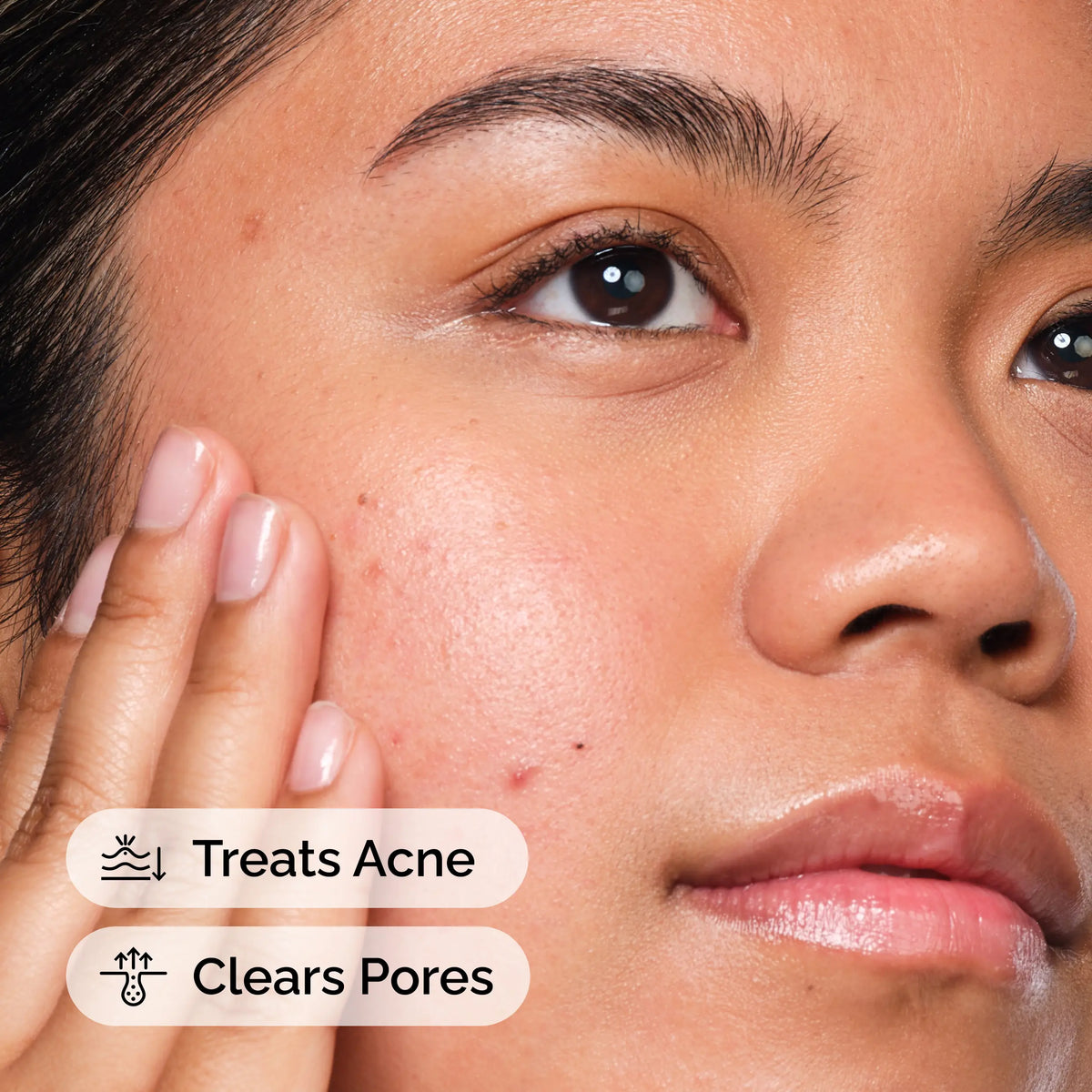 The Ordinary Acne Set (3 pasos)